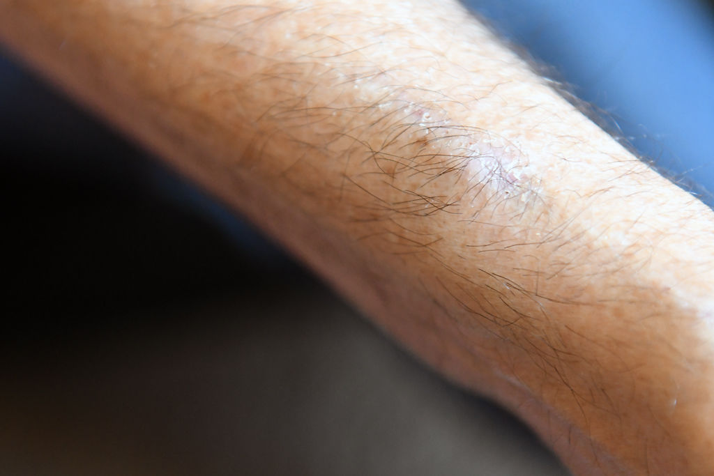 Denny Sercu shows a dead blood vein, a consequence of injecting drugs